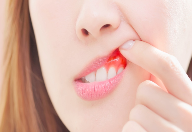 Woman showing red, inflamed gums illustrating gingivitis vs. periodontitis in Fremont, IN